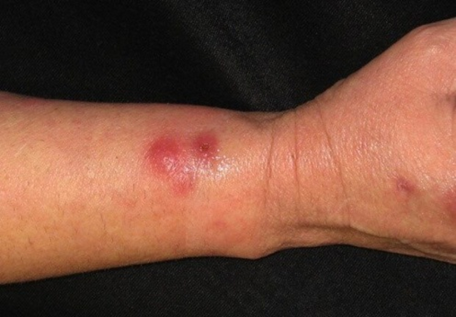 Esporotricose tem notificação compulsória