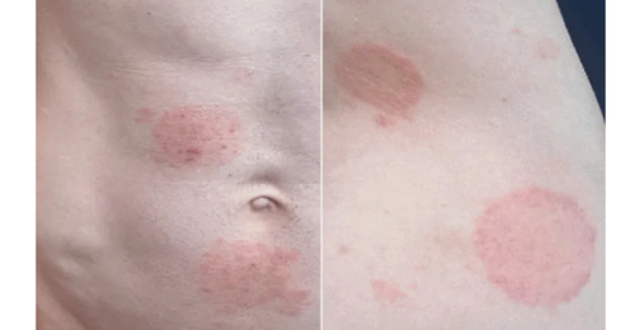 Fungo transmitido pelo sexo gera alerta.