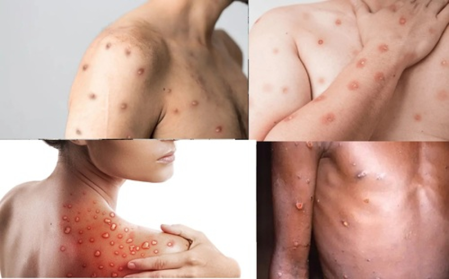 Saúde confirma 55 casos da Mpox no Brasil.
