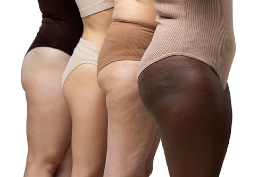 Saiba mais sobre Lipedema e linfedema.