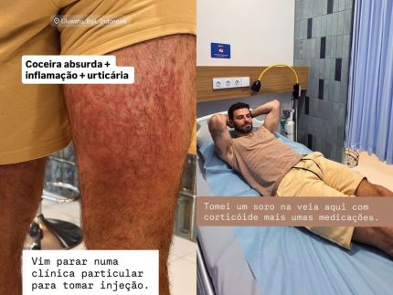 Ator é hospitalizado a após  ataque de ácaros