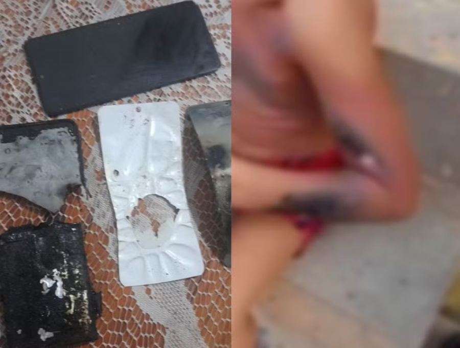 Menino de 6 anos tem corpo queimado após celular explodir