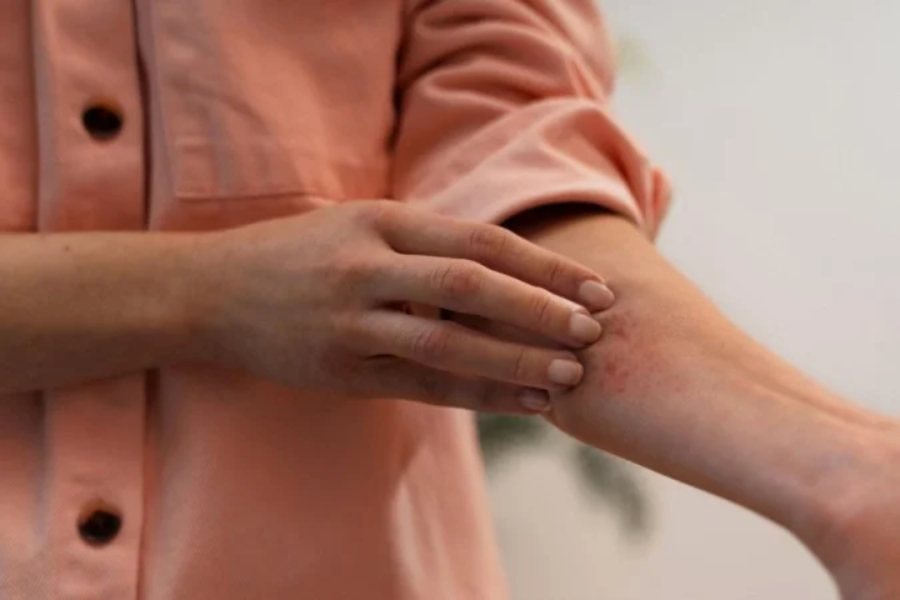 Dermatite atópica exige tratamento adequado.