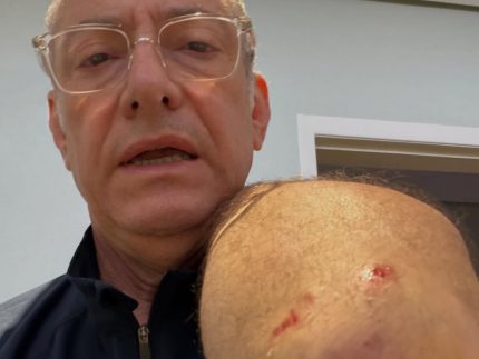 Âncora da Globo é atacado por pitbull em SP