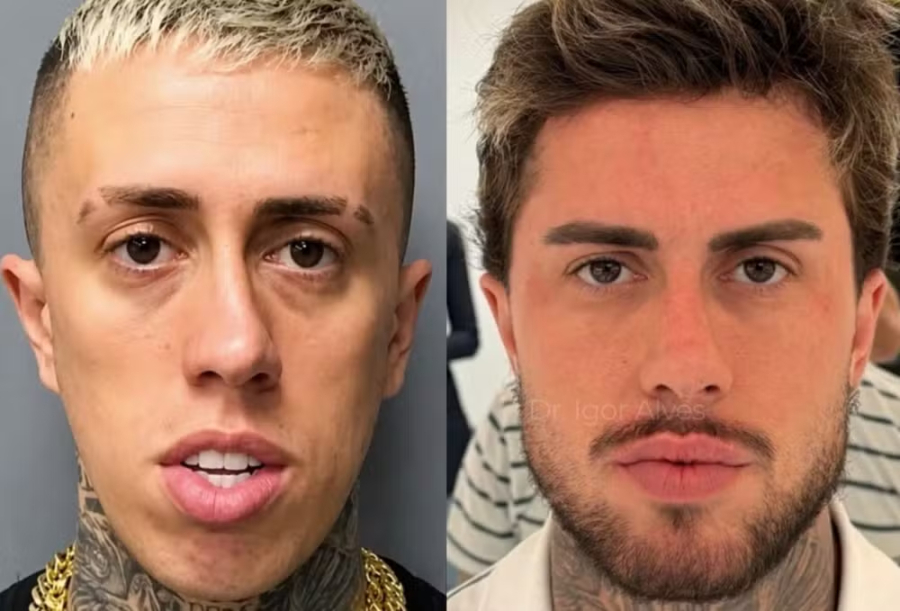 O antes e depois de famosos que fizeram harmonização.