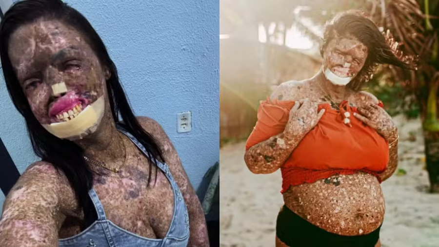 Jovem morre após enfrentar doença rara e câncer