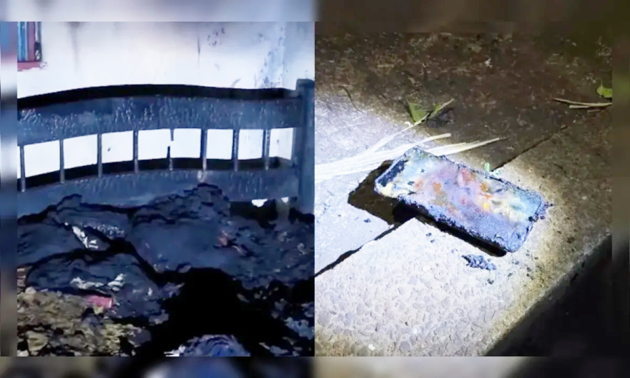 Homem queimado após celular pegar fogo segue em caso grave.