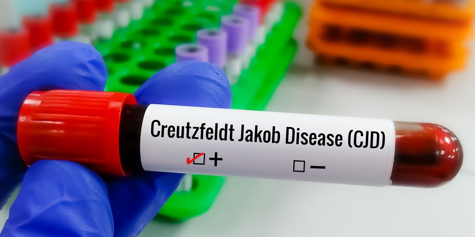 Entenda Doença de Creutzfeldt-Jakob