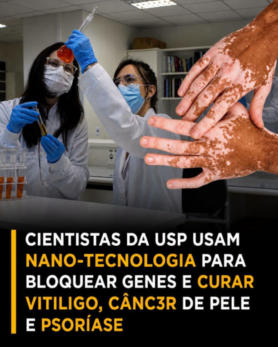  Nanotecnologia pode tratar Psoríase e Vitiligo.