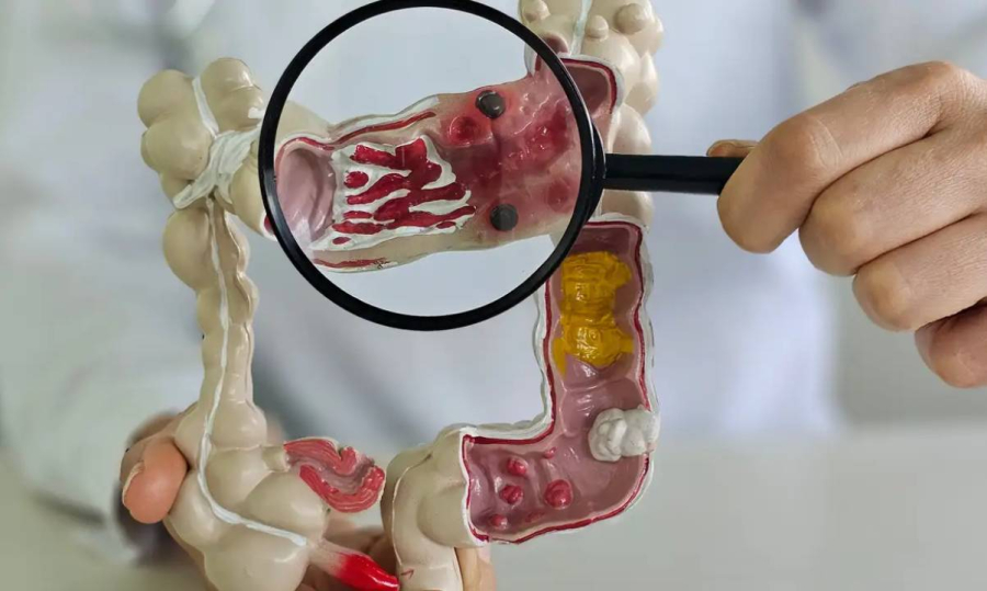 Doença intestinal cresce 5 vezes no Brasil.