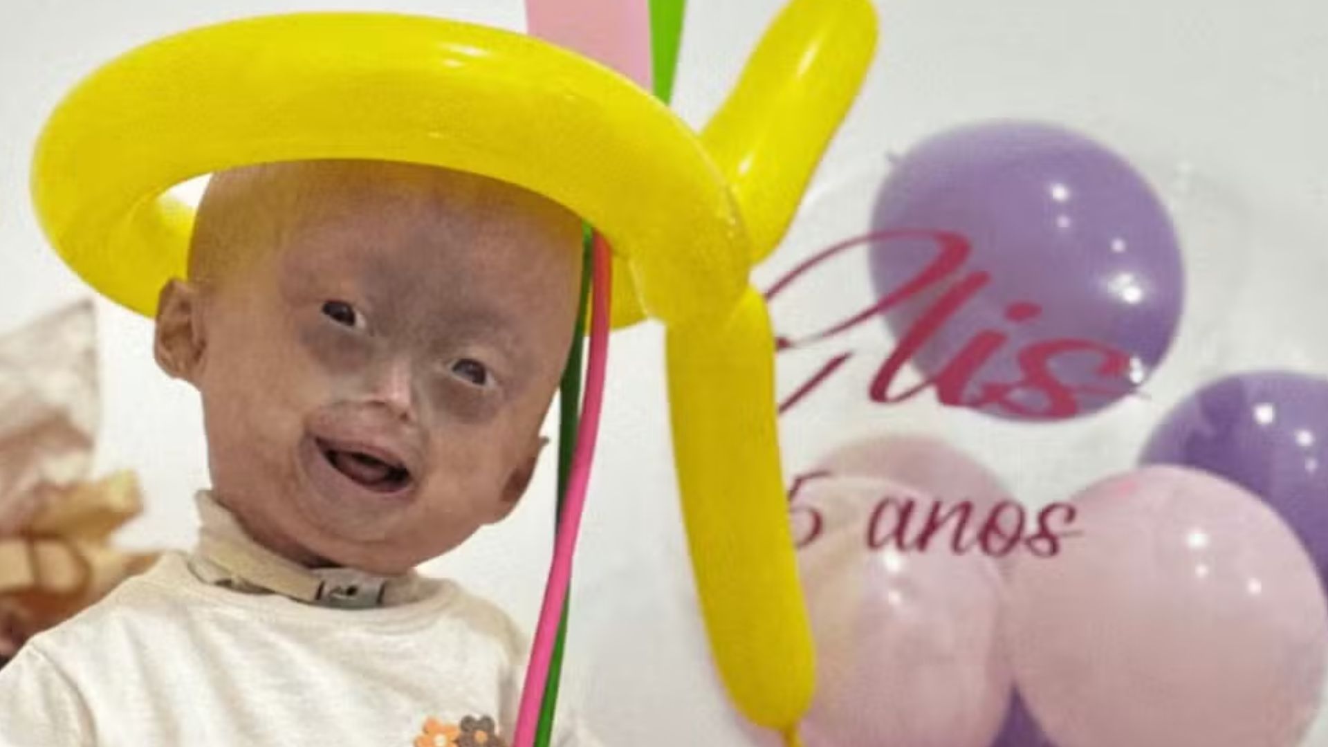 Gêmea diagnosticada com síndrome rara morre aos 5 anos.