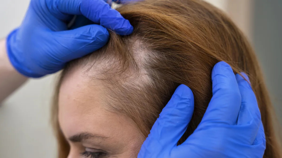 Entenda por que nem toda queda de cabelo é calvície.