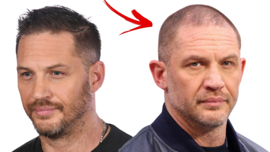 Tom Hardy confirma transplante capilar